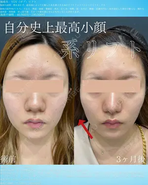 90 days after image