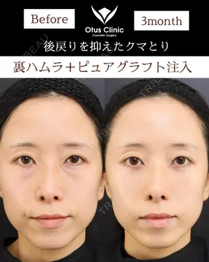 90 days after image