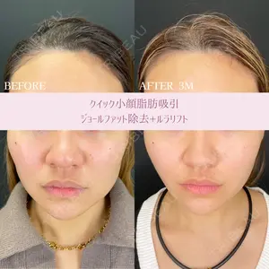 90 days after image