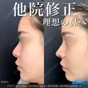 《MD式鼻尖形成3D法+軟骨移植+小鼻縮小内側法+ヒアルロン酸注入(鼻根)+他院修正》の症例 | トリビュー