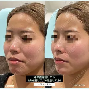 EMMO FACE CLINIC 大阪梅田院 山﨑 冴羅医師の症例