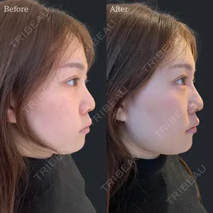 HAAB×DREAM BEAUTY CLINIC 東京本院 佐野 圭医師の症例