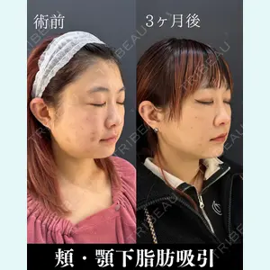 HAAB×DREAM BEAUTY CLINIC 東京本院 吉岡 修一医師の症例