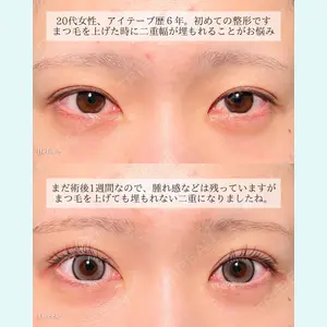 症例