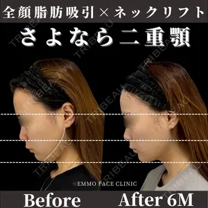 症例