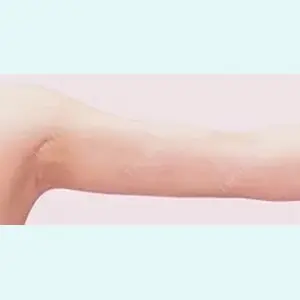 症例