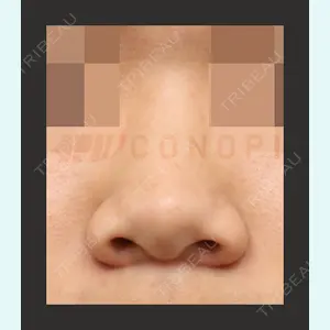 ビーザニュー美容整形外科（旧コノピ美容整形外科） ジョン・テヨン院長医師の症例