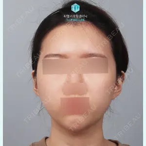 TL美容クリニック リフティング・皮膚管理センター チョン・ヨンホ代表院長医師の症例
