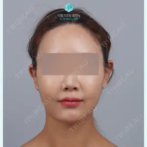 TL美容クリニック リフティング・皮膚管理センター チョン・ヨンホ代表院長医師の症例