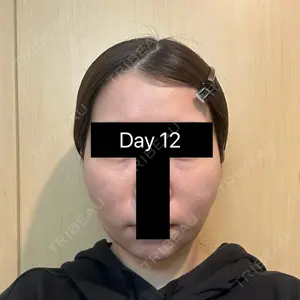 12 days after image