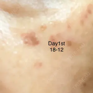0 days after image