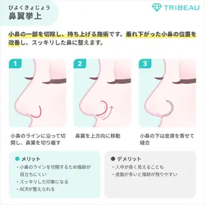 小鼻縮小（非切開）の解説画像6