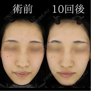 HAAB×DREAM BEAUTY CLINIC 大阪梅田院の症例