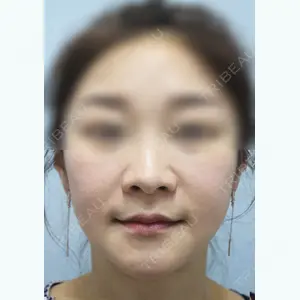 釜山フォーシーズン美容外科 諸葛正宰(ジェガル・ジョンジェ）/代表院長医師の症例