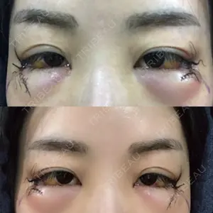 1 days after image