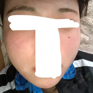 11 days after image