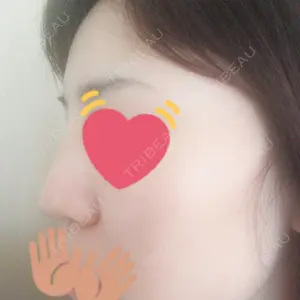 4 days after image