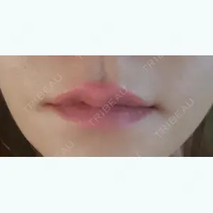13 days after image