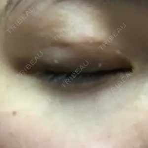 2 days after image