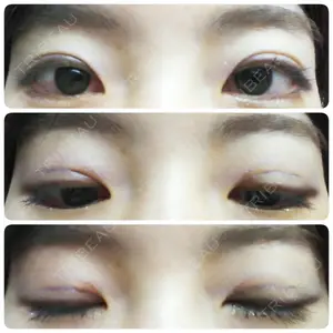 4 days after image