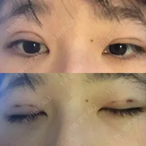 0 days after image