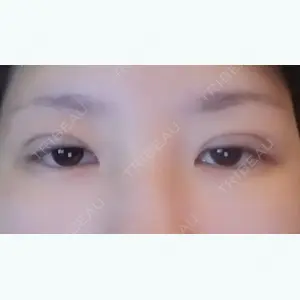 6 days after image