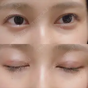 14 days after image
