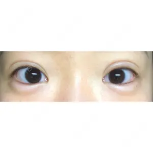 1 days after image