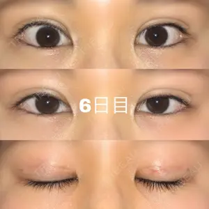 6 days after image