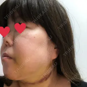 4 days after image