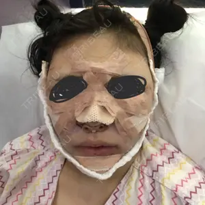 0 days after image