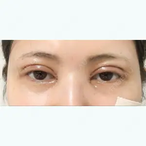 2 days after image