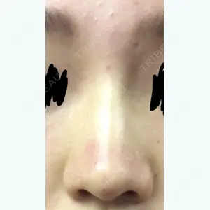 0 days after image
