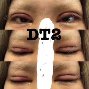 2 days after image