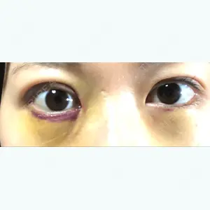 6 days after image