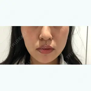 23 days after image