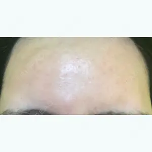 5 days after image