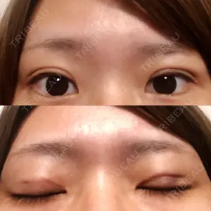 0 days after image