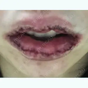 1 days after image