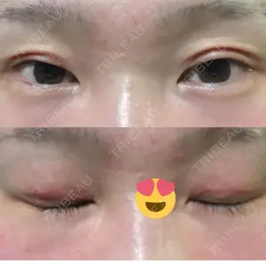 0 days after image