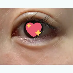 11 days after image