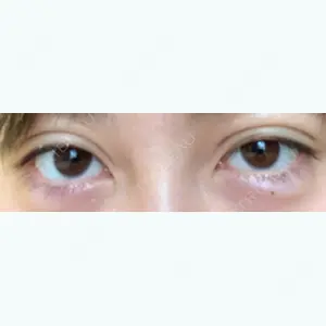 1 days after image