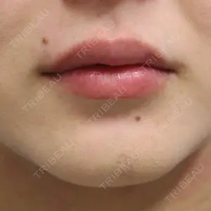 0 days after image