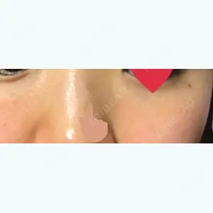 94 days after image