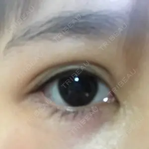 0 days after image