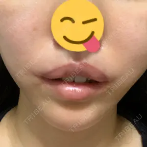 15 days after image