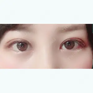 17 days after image