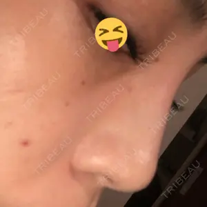 14 days after image
