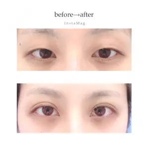 1 days after image