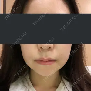 14 days after image